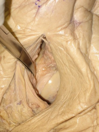 Anterior approach to the hip