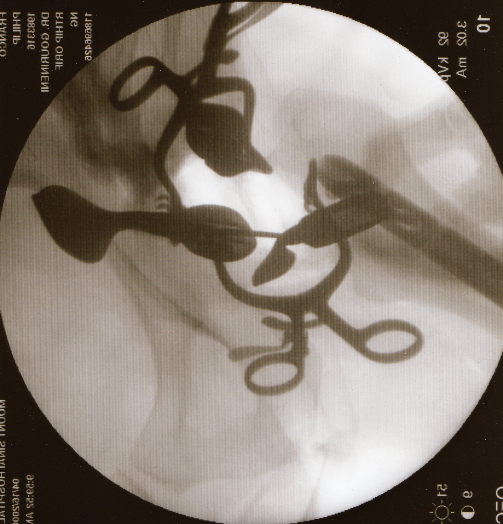 Femoral neck fracture fixation through anterior approach