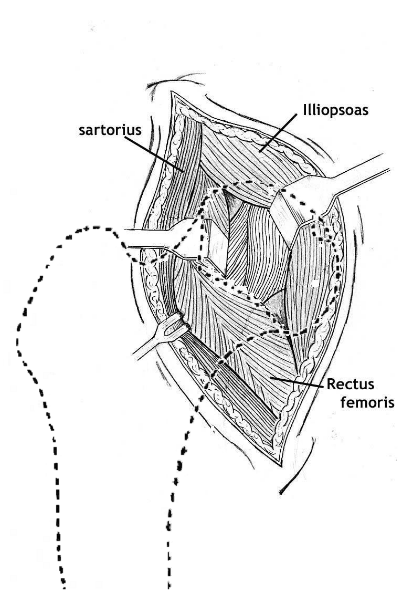 Anterior approach — additional view