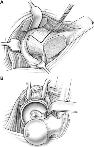Safe surgical dislocation of the hip — trochanteric flip osteotomy and anterior dislocation