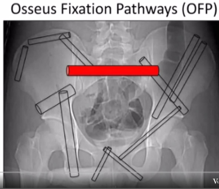 Seven bone corridors of the pelvis