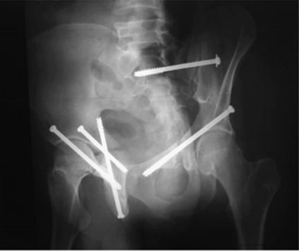 Seven bone corridors — pelvic diagram