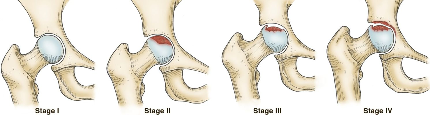 Ficat staging of avascular necrosis of the femoral head — Stage I through Stage IV