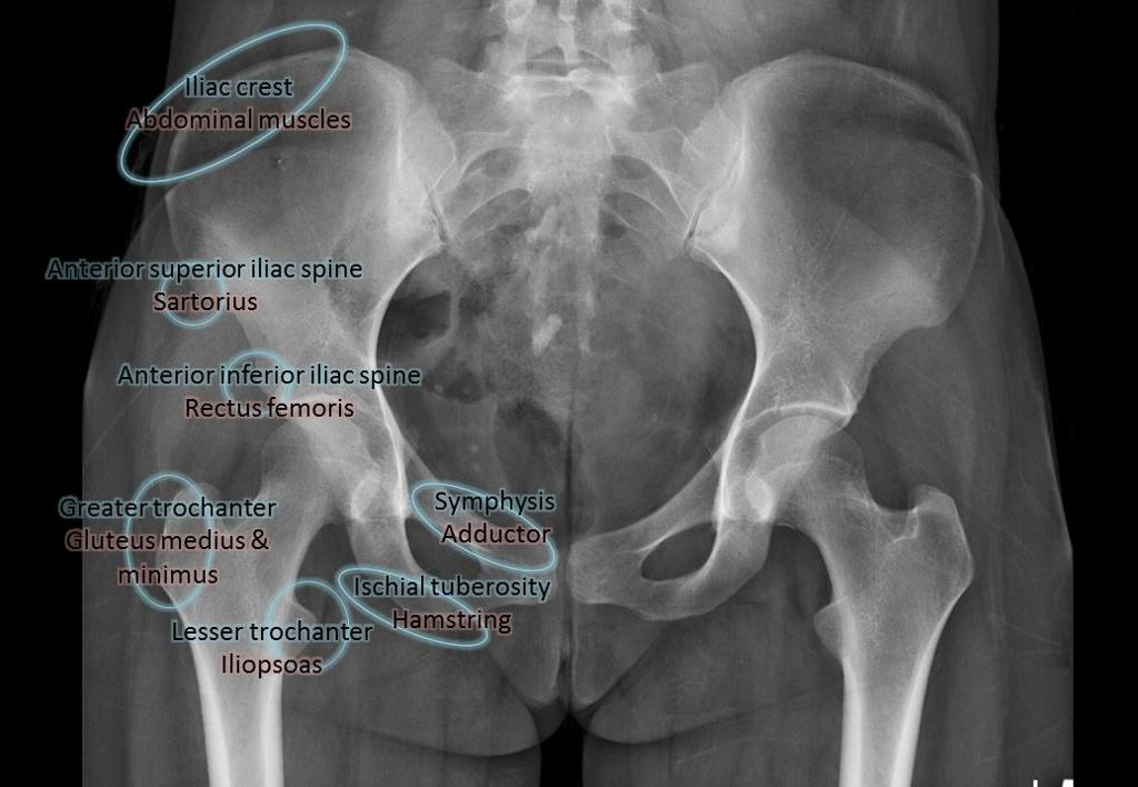 AP pelvis X-ray annotating avulsion fracture sites: iliac crest, ASIS, AIIS, greater trochanter, lesser trochanter, ischial tuberosity, and pubic symphysis with corresponding muscle attachments