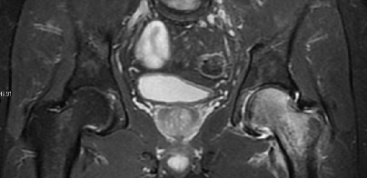 MRI of the pelvis showing diffuse edema in the left proximal femur