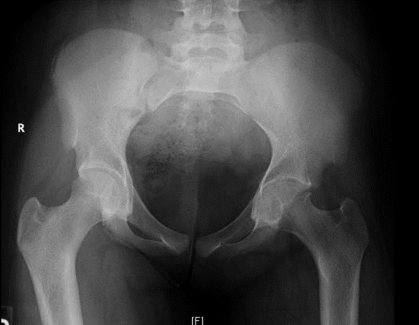 Chondrolysis X-ray