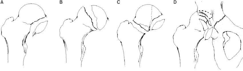 Pipkin classification of femoral head fractures — types A through D