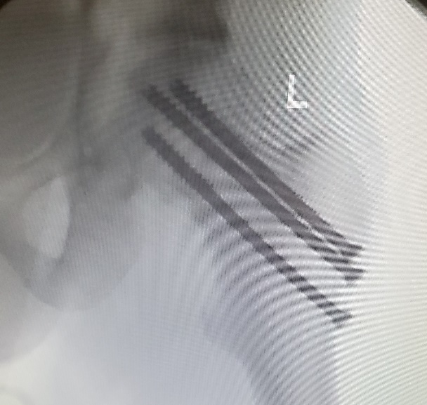 Left femoral neck fracture treated with valgus reduction and parallel screw fixation