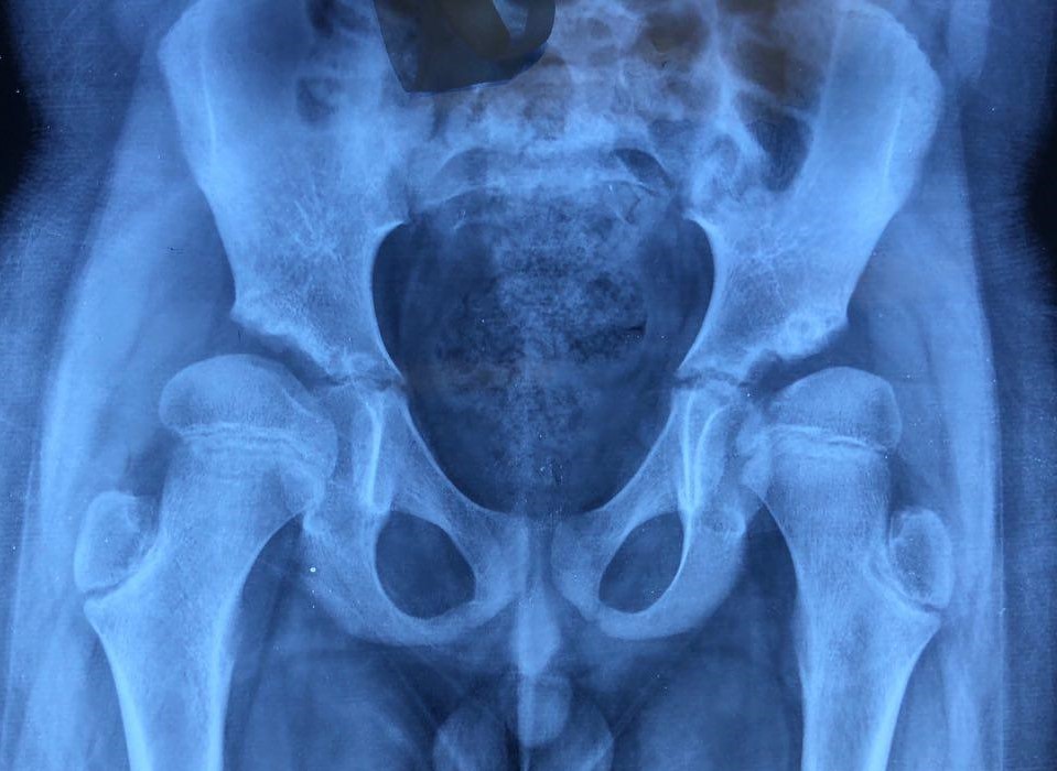 Foveal loading from coxa valga — fovea in contact with the acetabular dome