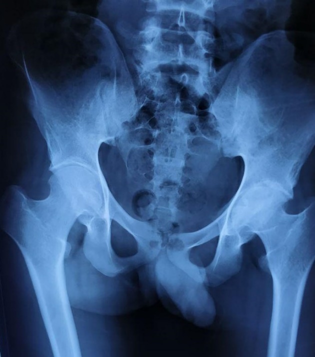 Foveal loading from high acetabular fossa and downsloping sourcil causing medial osteoarthritis