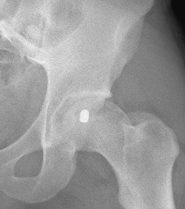 Retained bullet in the left femoral head