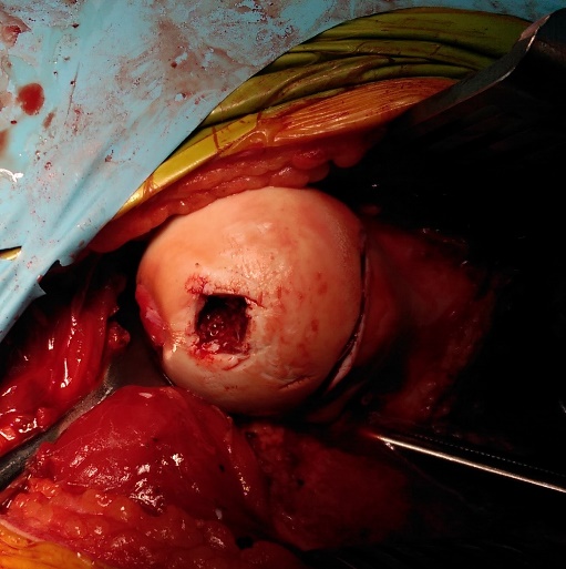 After surgical dislocation and bone and cartilage grafting