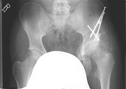Heterotopic ossification of the left hip developed a few months after periacetabular osteotomy