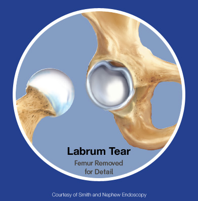 Types of acetabular labral tears
