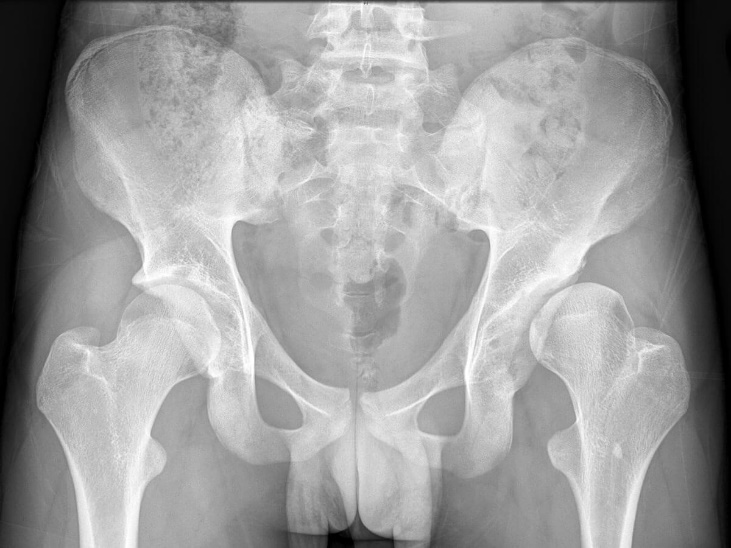Left hip dysplasia with femoral head subluxation