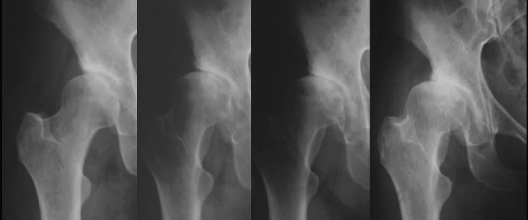 Natural progression of dysplasia with subluxation to severe arthritis