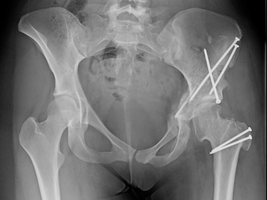 Left hip severe dysplasia with coxa vara and magna treated with PAO and RNL