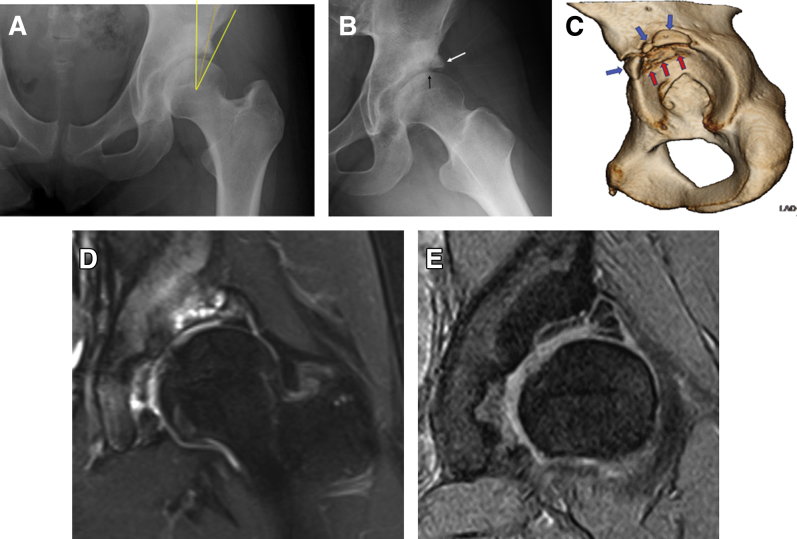 Osteochondritis dissecans of the hip