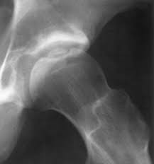 Osteochondritis of the acetabulum
