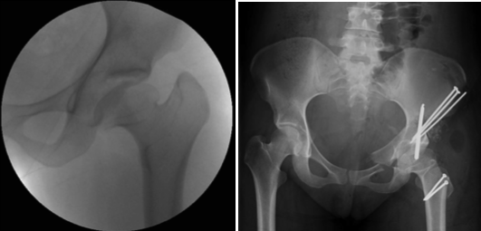 Coxa magna, breva, vara, and acetabular dysplasia treated with RNL and PAO