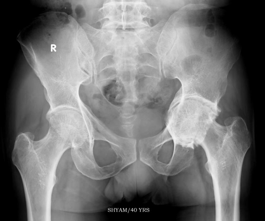 Bilateral protrusio with negative sloped sourcils and medial osteoarthritis on the left side
