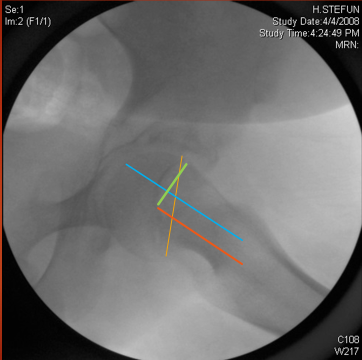 Slipped capital femoral epiphysis