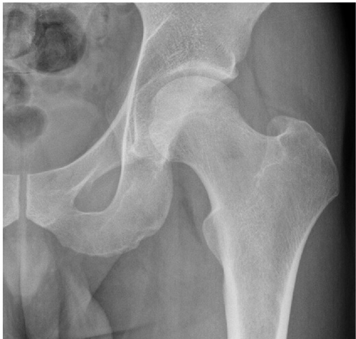 Tuberculosis of the hip — radiographic findings