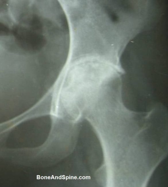 Tuberculosis of the hip — advanced joint destruction
