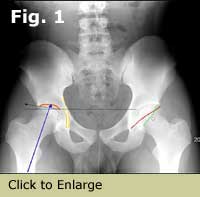 AP pelvis showing sourcil, sourcil angle, weight bearing axis, fovea and tear drop on the right hip, and posterior wall sign and cross over sign on the left hip