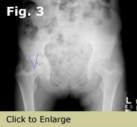 Caput valgum — superiorly placed fovea