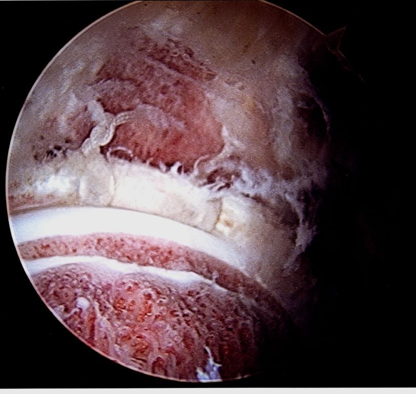 Acetabular rim trimming