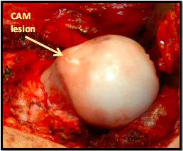 Anterior cam deformity of the left hip seen after surgical dislocation