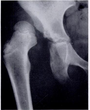 Dislocated right femoral head with very shallow acetabulum