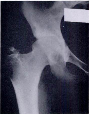 Reduced right femoral head after capsular interposition