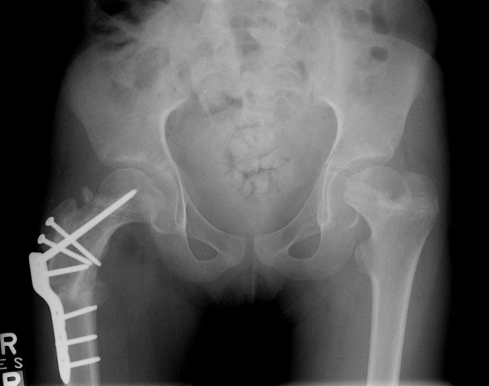 Identical bilateral Caput valgum, coxa vara, coxa breva corrected on the right side with relative neck lengthening and Varus osteotomy