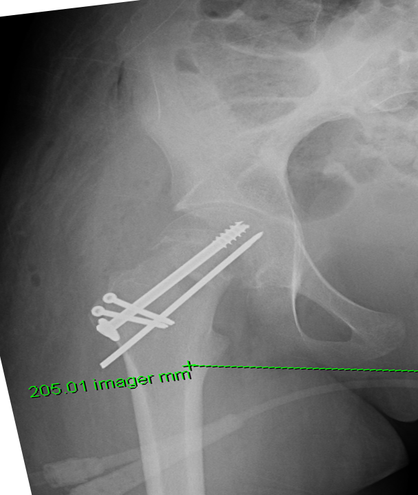 Femoral head fused to the back of the neck from a severe slip
