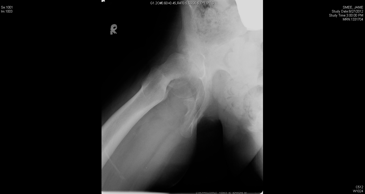 Femoral neck osteotomy with complete correction of the slip