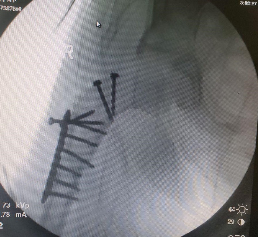 Head reduction technique