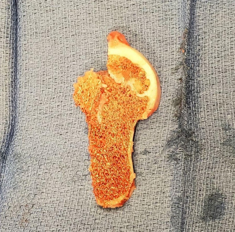 Head reduction — intraoperative view