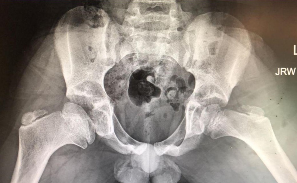 Head reduction — result