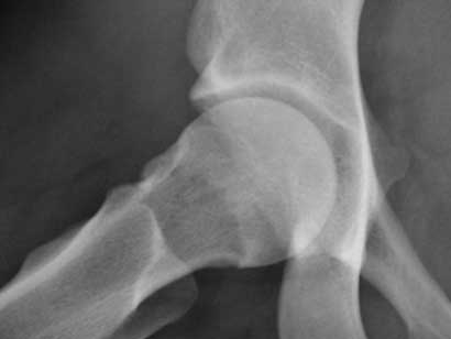 Hip arthroscopy