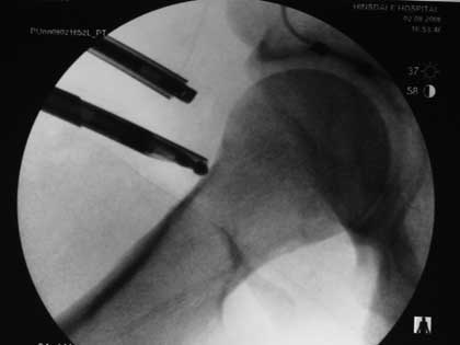 After femoral neck osteotomy
