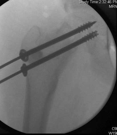 Severe slip treated with arthroscopic Dunn type of femoral neck osteotomy