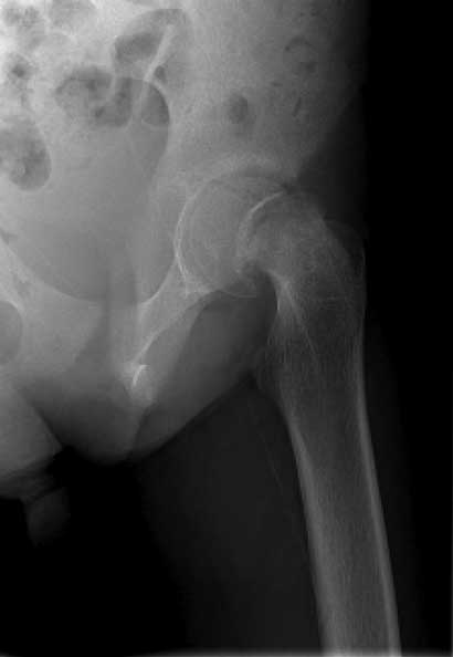 Severe unstable slipped capital femoral epiphysis