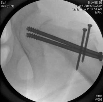 Surgical dislocation and subcapital reorientation