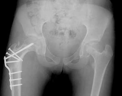 Bilateral caput valgum correction