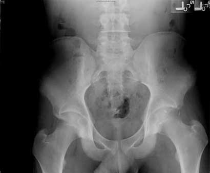 Anterior approach for acetabular retroversion