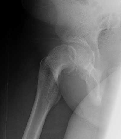 Severe slip treated with arthroscopic Dunn type of femoral neck osteotomy