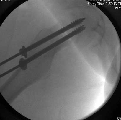 Severe slip treated with arthroscopic Dunn type of femoral neck osteotomy