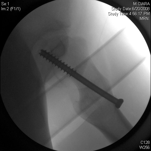 Percutaneous screw technique